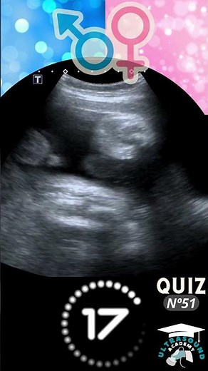 Ultrasound Quiz-51: Can You Guess? Boy or Girl? | Quiz-51 | #ultrasound #babygenderprediction