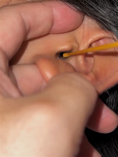 Ear Wax Removal: Satisfying Ear Cleaning Video You Can't Miss