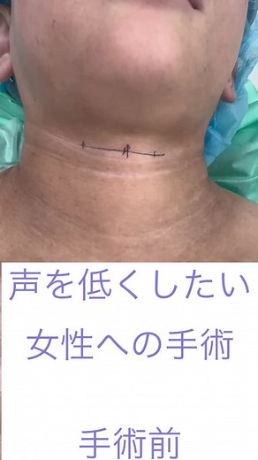 声の手術でイケボを手に入れよう