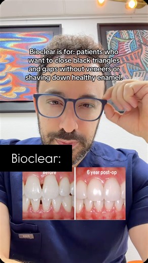 Dr. Erez Cohen LANAP Dentist on Instagram: "A really great option for patients who value conservative dentistry but still want cosmetic, esthetic results. FYI, not my cases but we will be offering the treatment in our office Feb 1st 2026 ☺️. #oralhealthcare #bioclear #veneers #compositeveneer #blacktriangle"