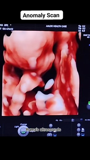 Realtime Scan(Anomaly Scan) 21 Wks 1 day #realtime #4D #anomalyscan | Ruma's Ultrasound