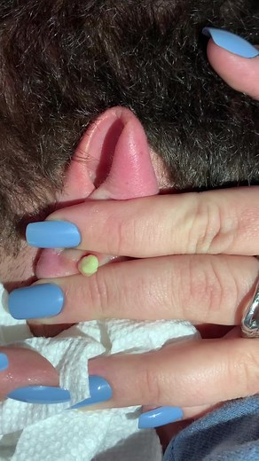Satisfying Cyst Removal Video by Dr. Pimple Popper