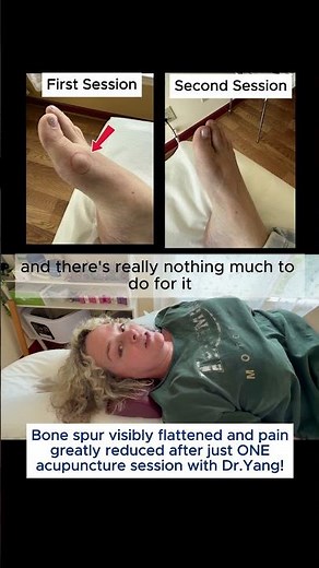 Bone Spur Flattened & Pain Reduced After Just ONE Acupuncture Session! | Patient Testimony