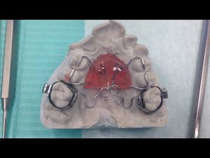 Fitting and Adjusting the Pendulum | Athanasios Nasiopoulos Orthodontist Thessaloniki - Edinburgh