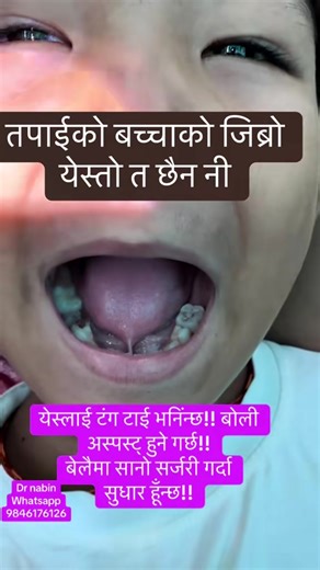 Understanding Tongue Tie: Causes and Treatments