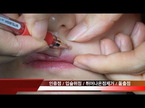 입술 위 큰 점 튀어나온 점의 수술적 제거 Big Mole Removal Surgery (4K) 닥터랜사부 제공