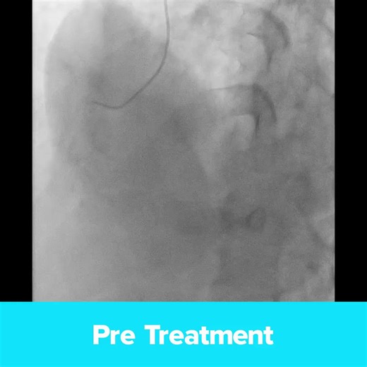 Does #ShockwaveIVL enable compression of calcified nodules? That’s Dr. Shoichi Kuramitsu’s hypothesis after treating a 61-year-old male patient with exertional chest pain. Initial angiography showed severe stenosis of the mid RCA with heavy calcification, and OCT revealed noneruptive calcified nodules. Dr. Kuramitsu tried a 3.0mm cutting balloon before IVL, but it could not expand fully, even at 20 atm. So then, Dr. Kuramitsu used a 3.5mm #CoronaryIVL device to modify the calcium, and the balloo