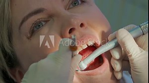 the dentist drills a hole in the tooth of a young woman close-up. dental treatment, fillings, caries