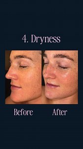 From subtle refreshes to full glow-ups, our Caci experts specialise in age-defying results that look beautifully natural. See this months offers. 💙 Confidence, expertise, and care. Book a free skin scan consultation with your local Caci Clinic. 75 Clinics nationwide. | Caci