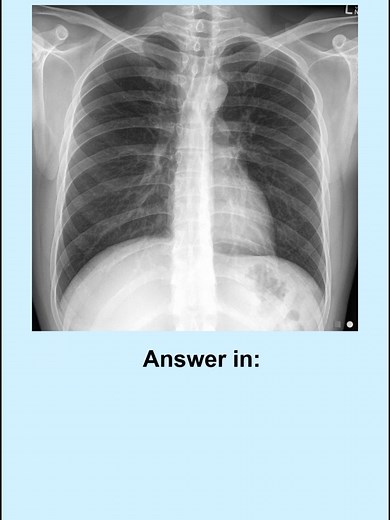 Chest X-ray Quiz for Medical Students