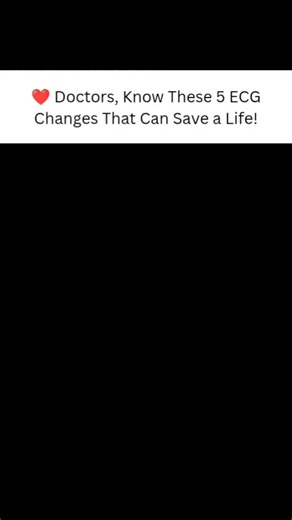 Antibiotics mistakes on Instagram: "Some ECG changes can point to life-threatening conditions. ST elevation in leads II, III, and aVF suggests an inferior heart attack, which may also affect the right side of the heart. ST depression in V1–V3 with tall R waves could mean a posterior MI, often missed if not checked carefully. Peaked T waves may signal high potassium levels, which need urgent treatment. A prolonged QT interval increases the risk of a dangerous rhythm called torsades de pointes. An
