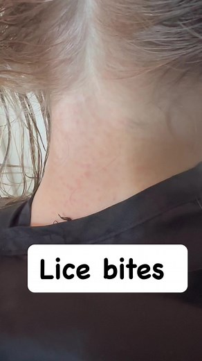 An indication, a person has head lice is a rash at the nape of the neck. As you can see this client did have a rash, and it was a result from having head lice. I did ask mom if she’s had this rash before she says she has not. #explore #lice #momlife #Piojos #hair | Stacey The Louse Lady