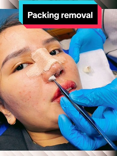 Nasal packing removal 3 days after rhinoplasty #nasalpacking #packingremoval #splintremoval #septoplasty #rhinoplasty #sinusrelief