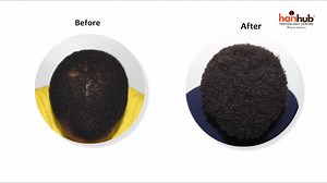 Here is why Jet Peel PRP is a plus for your PRP sessions! #hairgrowth #hairrestoration #haircare #PRP #thickhair #confidence | Hair Hub-The Trichology Centre | Facebook
