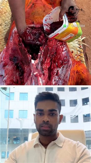 Dr. Isacc Abbas on Instagram: "Drinking raw pig blood can be deadly. Streptococcus suis bacteria can cause meningitis, sepsis, and organ failure, while Hepatitis E virus (HEV) in pig blood can damage the liver. Stay safe by avoiding raw animal products and following proper hygiene.  #diet #viralfood"