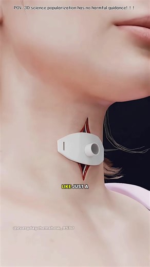 Tracheotomy Procedure 3D Animation #tracheotomy #windpipesurgery #tracheasurgery #patienteducation #medical3danimation