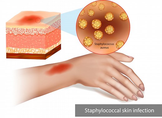 Cellulite infectieuse : causes, symptômes et traitements