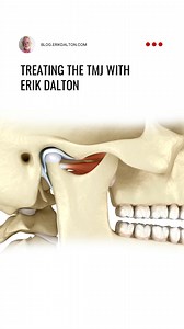 Treating the TMJ with Erik Dalton Massage therapists are familiar with the temporomandibular joint (TMJ) located just in front of the ears on each side of the head. Disorders can arise in this complex and highly specialized joint for several reasons including misalignment, arthritis, and excessive muscle tension causing pain, clicking or popping sounds, restricted movement, and headache. In this blog post and demonstration video, Erik talks about TMJ disorders and demonstrates techniques to supp