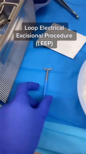 3.1K views · 38 reactions | A LEEP (Loop Electrode Excisional Procedure) is a procedure performed on the cervix to remove pre-cancerous cells. The sample can also be sent to pathology for evaluation to make sure the abnormal cells were removed. A LEEP can be done under anesthesia or in the office with a lidocaine cervical block. This procedure can be therapeutic and diagnostic! 🙌 #drmikaelarush #obgyn #doctorsofinstagram #leep #cervix #cervicaldysplasia #precancerouscells | Dr. Mikaela Rush | F