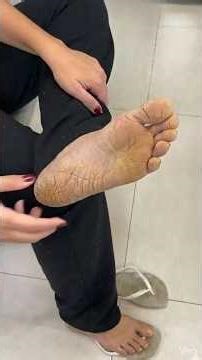 Get rid of cracked feet with just 2 ingredients!