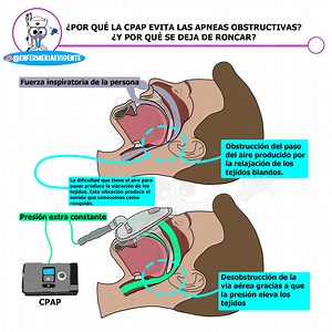 ¿Cómo funciona una CPAP?
