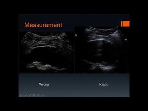 Sonography of the Aorta