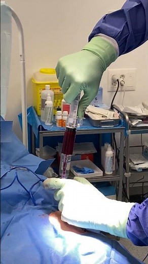 Extracción de células madre de médula ósea: la solución definitiva a tu artrosis de rodilla o cadera
