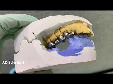 Metal Framework Try In Procedure !!!!!!