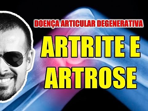 Artrite e Artrose - Doença Articular Degenerativa - Anatomia Humana - Articulações - VideoAula 085