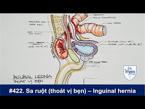 #422. Bệnh sa ruột (thoát vị bẹn) triệu chứng, chữa trị, và cách ngăn ngừa