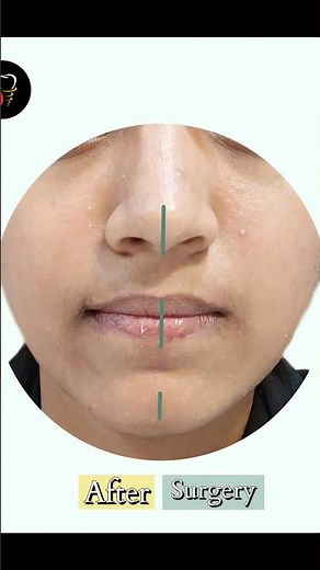 Facial Asymmetry Treatment: Before and After