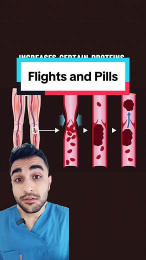Understanding DVT Risk with Contraceptive Pills During Flights