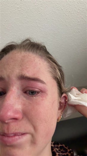 i just thought i need to show this traumatic story some more if you’re not on my private story.. also this is your sign to clean your piercings and don’t pierce your ear with a thumbtack