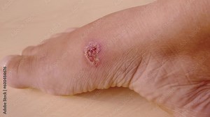 closeup of weeping wound, trophic ulcer on female leg, wound exudate prevents healing ulcers by destroying growth factors, concept of eliminating inflammatory process, sanitation pathogenic microflora