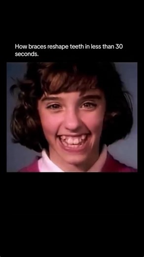 how stuff performs on Instagram: "This timelapse shows the incredible process of how braces slowly shift teeth into alignment, condensed into less than 30 seconds. What normally takes months or years happens here in a smooth transformation — teeth rotating, moving, and settling into their proper places as wires and brackets apply gentle, constant pressure. It’s a fascinating look at how orthodontics works beneath the surface, reshaping a smile millimeter by millimeter until everything lines up p