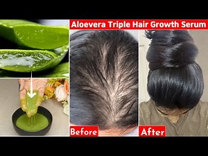 This👆🏼Aloevera Trick-Turned My Bald Hair to Thick Heavy Hair- 30 Days-Hair Loss to Thick Dense Hair