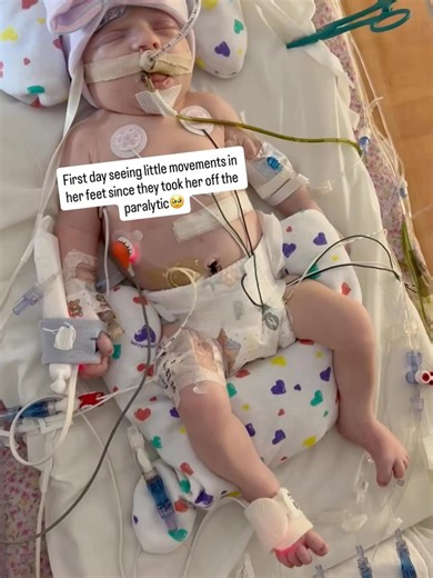CAT PAGES FOOR on Instagram: "The first week of June’s life: Baby girl underwent 2 surgeries in her first 6 days of life. She’s such a trooper💪🏼The first was her initial CDH repair surgery to move the organs out of her chest and repair the hole in the diaphragm. The second surgery was to put the rest of the organs back in her abdomen that couldn’t fit back in after the first surgery, then they sealed up the incision! Trying to memorize every part of her before her surgeries. Taking in every li