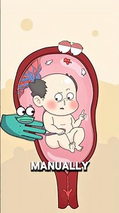 How Doctors Turn a Baby for a Safer Delivery 🤰👶..!!#e2dhealth #animation #fypシ #2dshow #health
