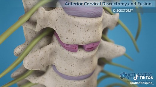 ACDF stands for Anterior Cervical Discectomy Fusion. It is one of the most common spine surgeries performed daily. It has a number of benefits, including a shorter recovery period less postsurgical pain. Remember to consult a doctor if you experience any discomfort in your back. Getting a proper diagnosis choosing the correct treatment are key to ease the pain. Atlantic Spine Center is located in NYC, NJ, Online. ✨ ACDF is recommended for: ▫️Cervical disc herniation ▫️Degenerative disc disease ▫