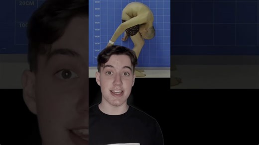 A man with severe spinal curvature finally stood upright