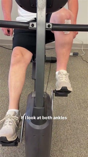 Full Revolution on Bike After Total Knee Replacement Surgery
