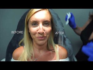 Cheek Augmentation using 1.5ml of Radiesse!