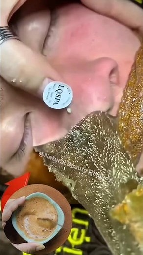 Remove Blackheads Permanently at Home ✨ Easy Blackheads & Whiteheads Removal Tips #blackheads
