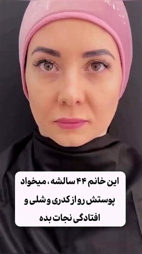 ‎لیفت و جوانسازی بدون تزریق |ضد لک|پپتاید کلاژن‎ on Instagram‎: "عدد 25 ارسـ.ـال کن💎تکـ.ـنیک کـ.ـلاژن هیـ.ـدرولیز شده و پـ.ـپتاید برای پوستت مـ.ـعجزه میکنه✨اگه میخوای راهـ.ـکارشو داشته باشی عدد 25 رو کا.منت کن بعدشم سریع دایر.کتتو چک کن💎 @avayejavani1 @avayejavani1 فقط یادت نره فا.لوم داشته باشی که پـ.ـیام هام برات بیاد عزیزم🦋❤️ @avayejavani1"‎