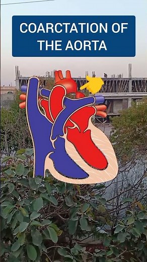 Coarctation of Aorta | Congenital Heart Defect Simplified
