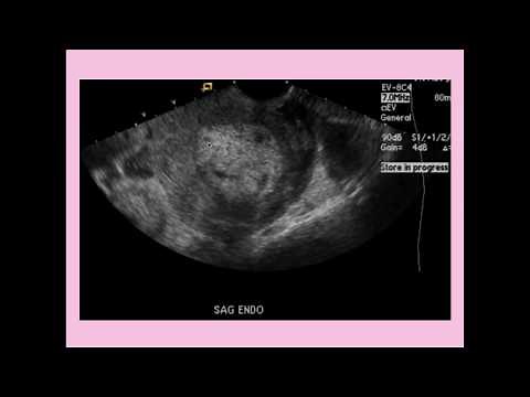 Endometritis - CRASH! Medical Review Series