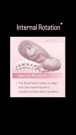 🔅Cardinal Movements of Labor: Internal Rotation🔅 👉 The cardinal movements of labor are seven distinct, sequential, and overlapping positional changes (engagement, descent, flexion, internal rotation, extension, external rotation/restitution, and expulsion) a fetus makes to navigate the maternal pelvis during birth. These movements align the smallest fetal head diameter with the birth canal, beginning with descent into the pelvis and ending in the delivery of the baby. 👉 With internal rotatio