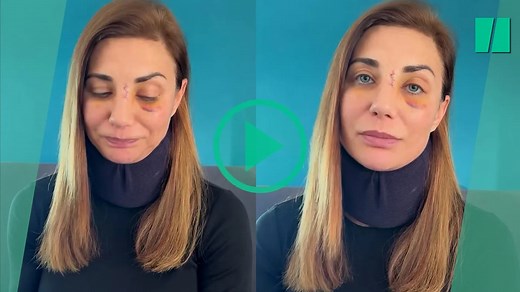 Ariane Brodier s’exprime sur la violente agression qu’elle a subie trois jours après une attaque de chien