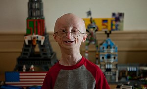 Sam Berns, face of progeria documentary, dies at 17 - UPI.com
