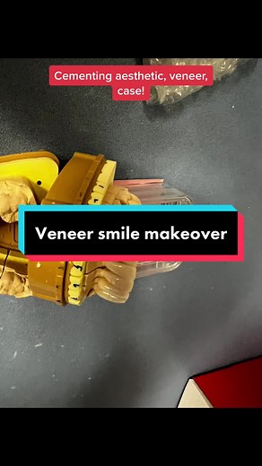 Cementing esthetic veneers for smile makeover Credit to Dr.Taheri. #Moneris #Smile #Makeover #Teeth.